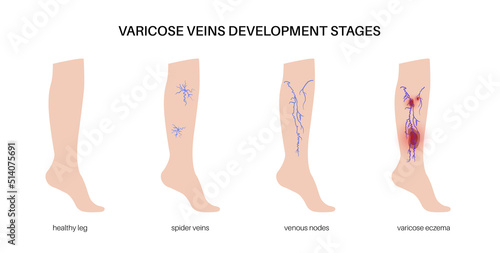 Varicose veins treatment