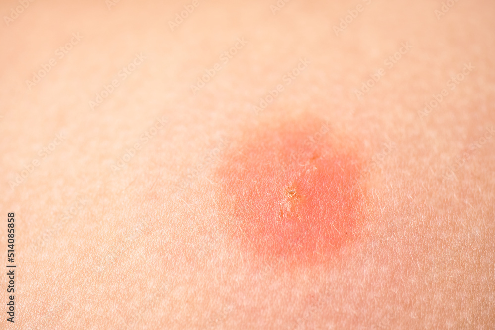 Fototapeta premium mosquito bite with red skin reaction around