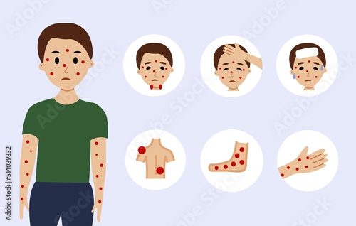 Monkeypox virus symptoms illustration with male character. Monkeypox outbreak concept by world health organization with examples and explanation. © Ariana Kattan