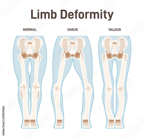 Limb anatomy scheme. Valgus and varus leg deformities. Diagram of normal