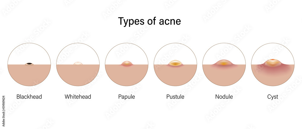 Types of acne. Skin problems. Blackheads, Whiteheads, Papules, Pustules ...
