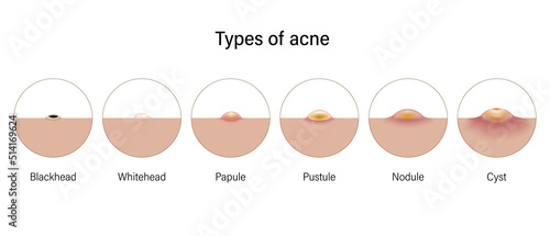 Types of acne. Skin problems. Blackheads, Whiteheads, Papules, Pustules, Nodules and Cysts. Vector for advertising about beauty and medical treatment. photo