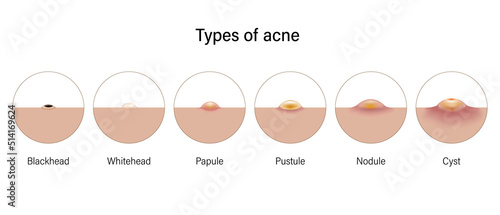 Types of acne. Skin problems. Blackheads, Whiteheads, Papules, Pustules, Nodules and Cysts. Vector for advertising about beauty and medical treatment.