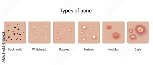 Types of acne. Skin problems. Blackheads, Whiteheads, Papules, Pustules, Nodules and Cysts. Vector for advertising about beauty and medical treatment.