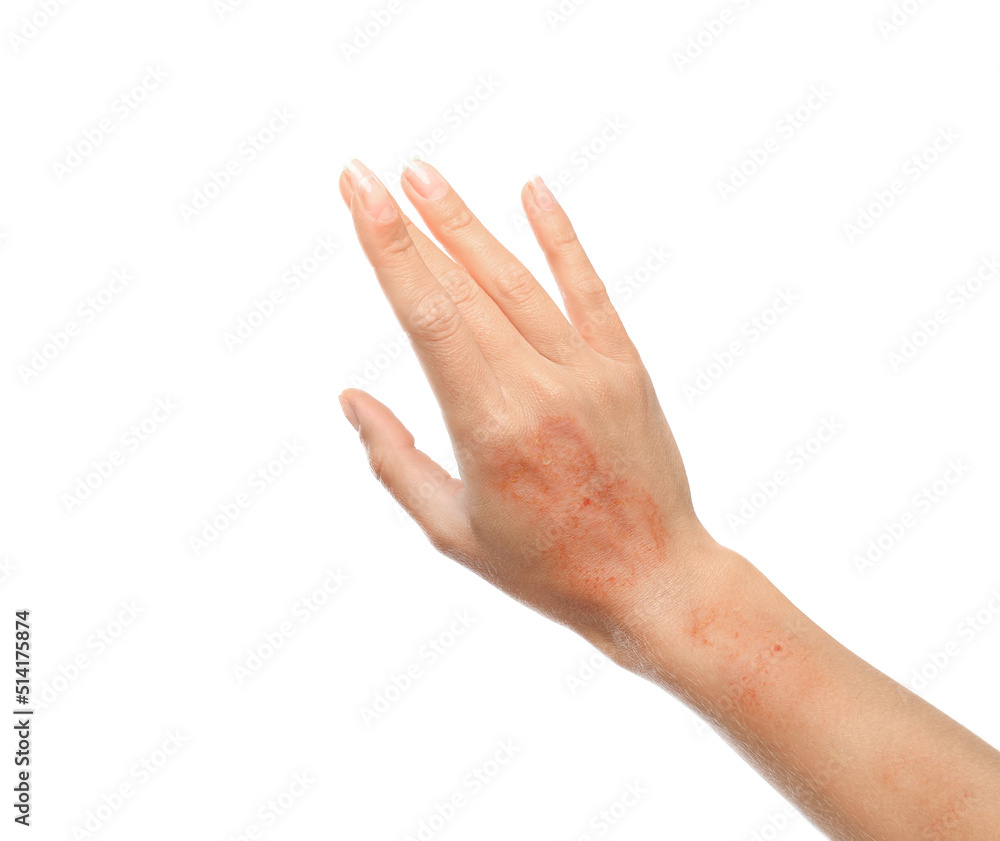 Woman showing hand with dry skin on white background, closeup