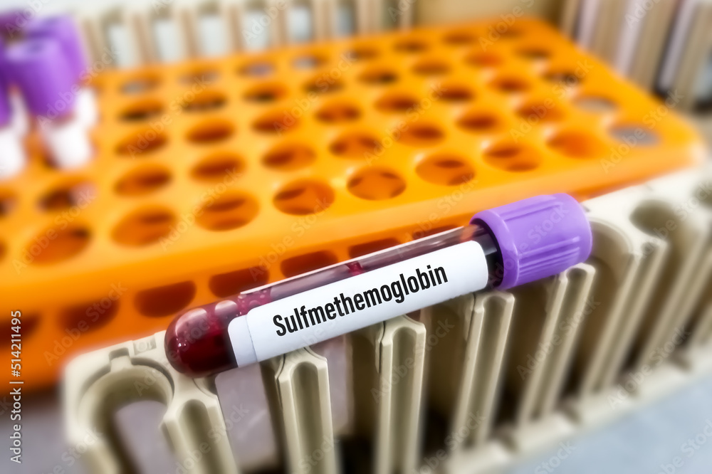 Sulfmethemoglobin blood test. The complex formed by the reaction of a sulfide and hemoglobin in the presence of oxygen.