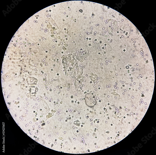 Microscopic image showing Calcium oxalate crystal and others urinary crystals from urine sediment.