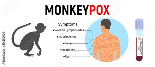 Banner with a silhouette of a monkey, a test tube for blood, with a text of the symptoms of monkeypox and a human body with a rash. Concept of a viral disease and its symptoms. Vector illustration.
