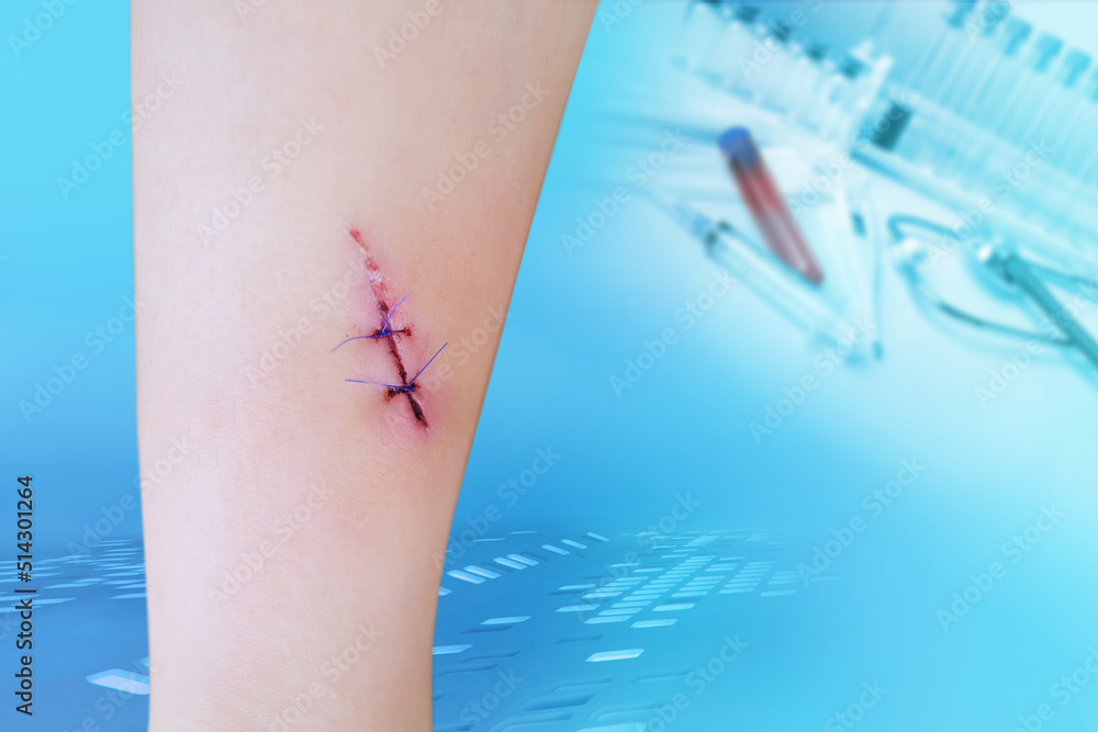 Fresh Sutured Wound On Child s Leg Wound Care In Hospital Non fresh-sutured-wound-on-child-s-leg-wound-care-in-hospital-non