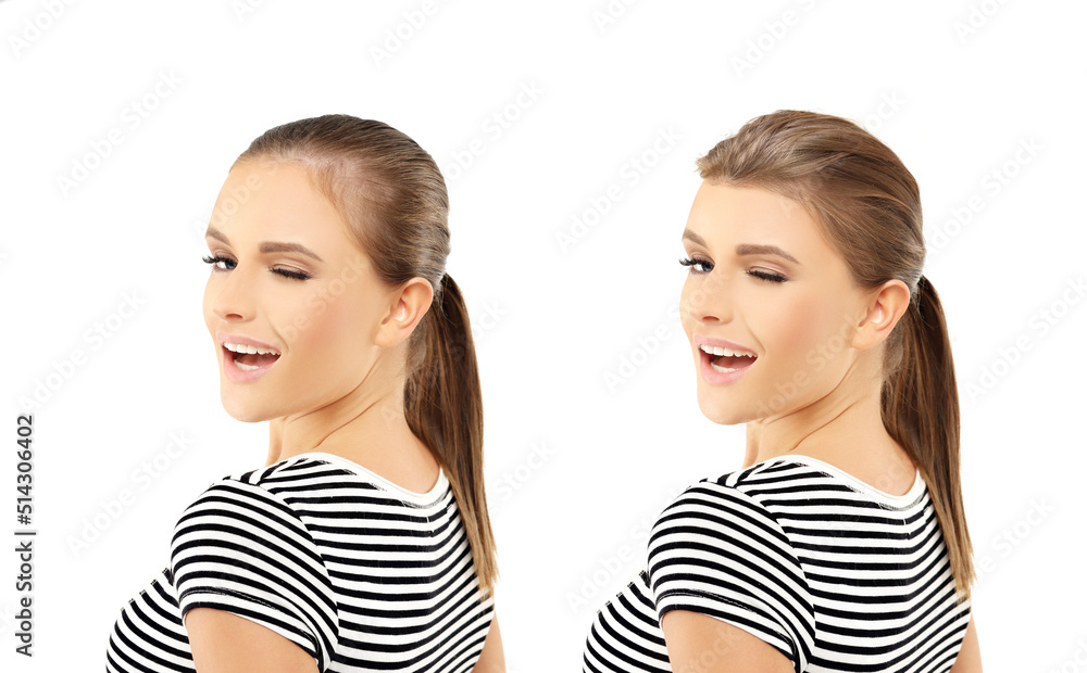 Thinning hair and hair loss,female pattern baldness,Hair transplant Thinning hair and hair loss,female pattern baldness,Hair transplant