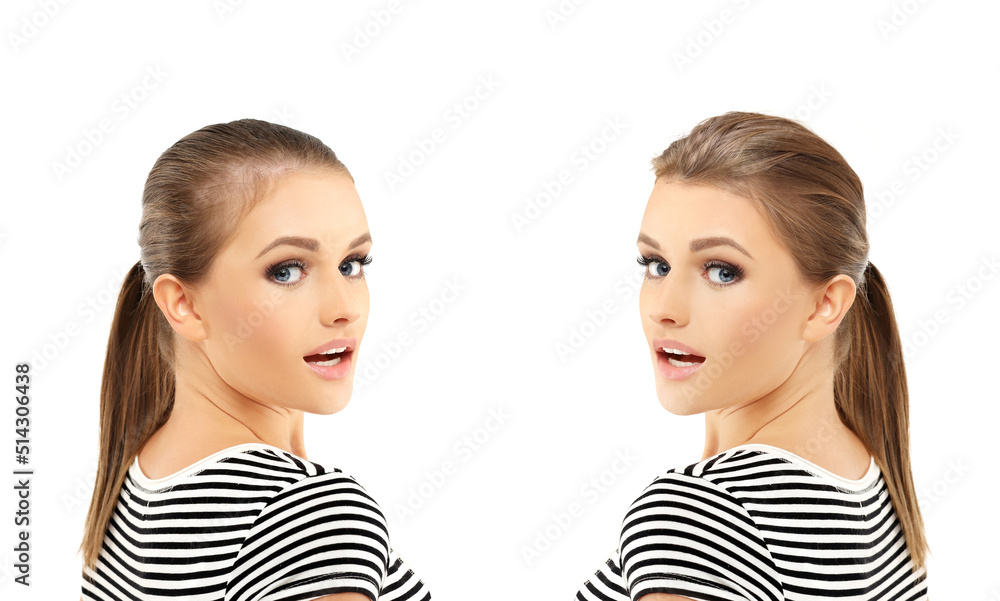 Thinning hair and hair loss,female pattern baldness,Hair transplant Thinning hair and hair loss,female pattern baldness,Hair transplant