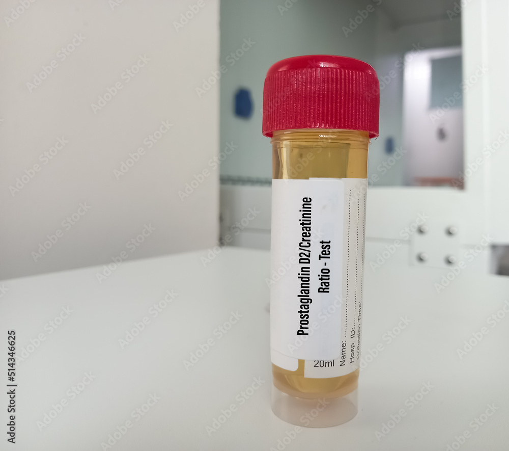 Urine sample for Prostaglandin D2Creatinine Ratio test, Aspirin
