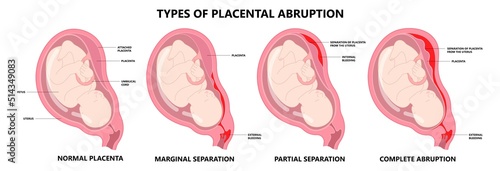 uterus cervix contraction and vasa previa fetal infant baby born c section nuchal cord twins fetus defect vessels funic labor growth low lying birth fluid of PROM test increta Bilobed sac neck knotted