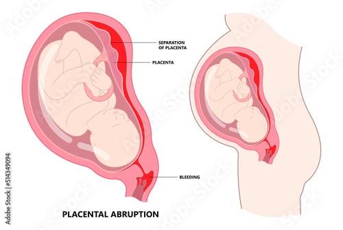 twins baby born and increta cervix vasa previa fetal infant c section nuchal cord fetus defect vessels funic labor growth low lying birth fluid of PROM test Bilobed sac uterus neck knotted Contraction