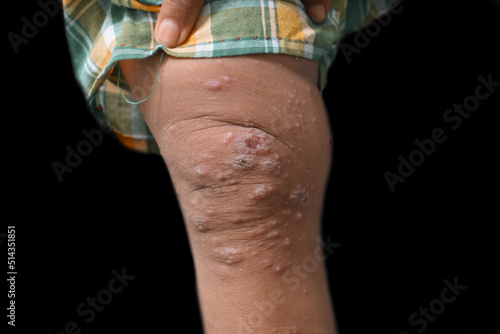 Scabies Infestation with secondary or superimposed bacterial infection and pustules in leg of Asian, Burmese child. photo