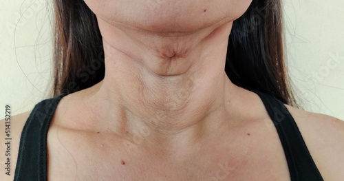 Portrait showing the flabbiness adipose hanging skin under the neck, problem wrinkles and flabby skin under the chin, concept health care.