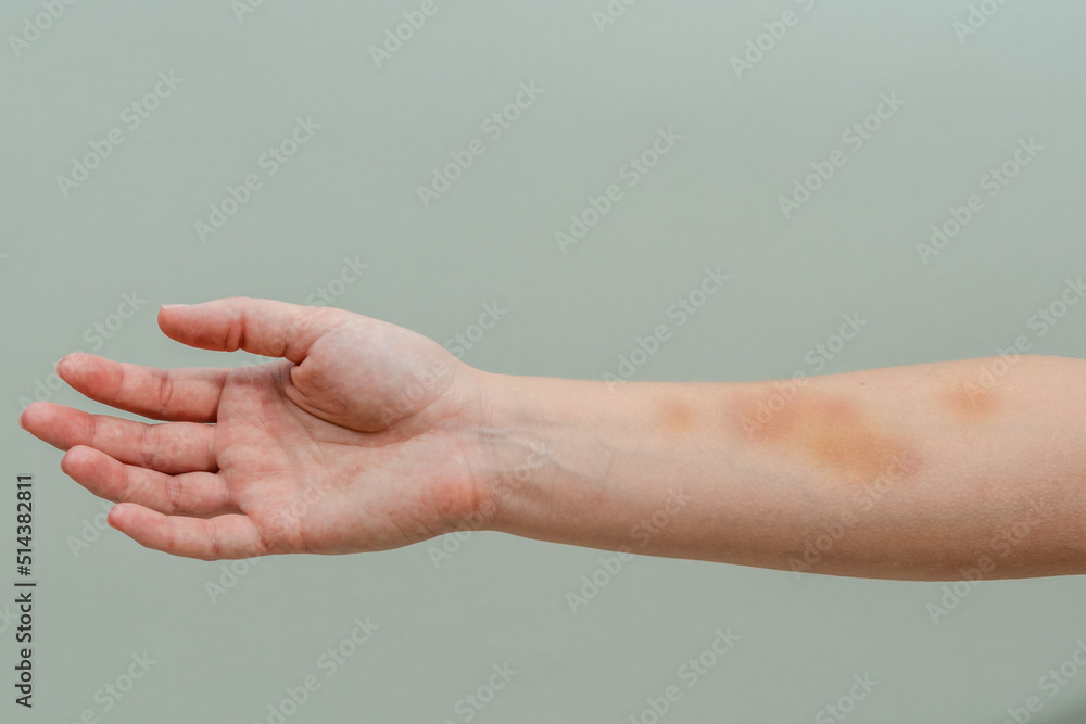 Large bruise on woman's arm isolated on white background Large bruise on woman's arm isolated on white background