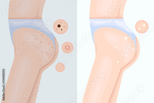 Before and after treating acne on the buttocks