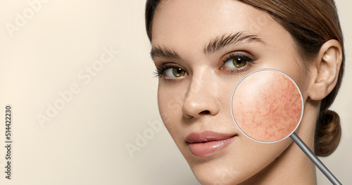Magnifying glass showing couperose on face skin. Woman showing problems couperose-prone sensitive skin