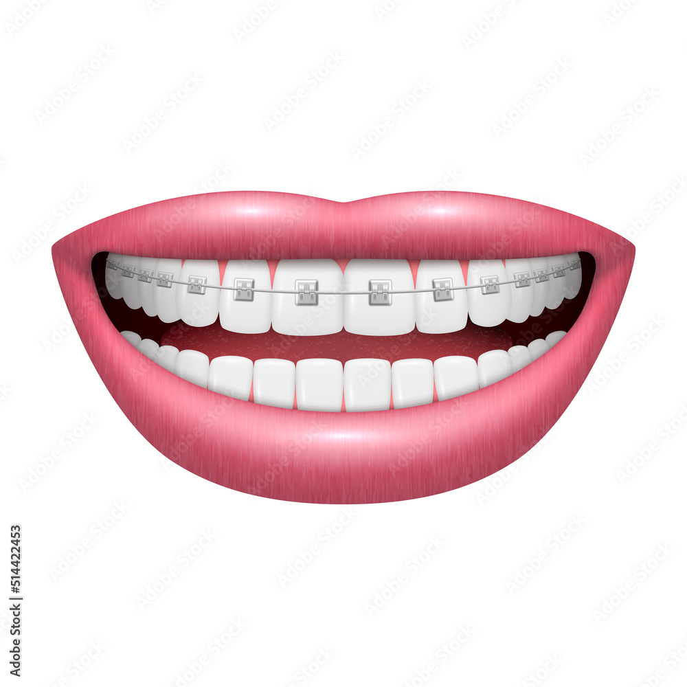 Installed braces on white smiling teeth open human mouth realistic 3d icon vector illustration Installed braces on white smiling teeth open human mouth realistic 3d icon vector illustration