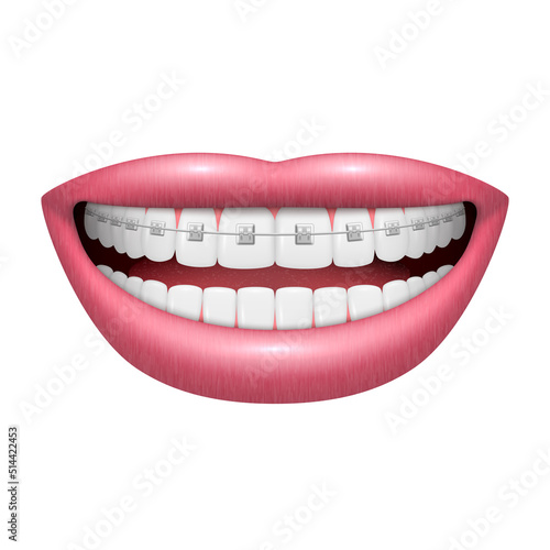 Installed braces on white smiling teeth open human mouth realistic 3d icon vector illustration
