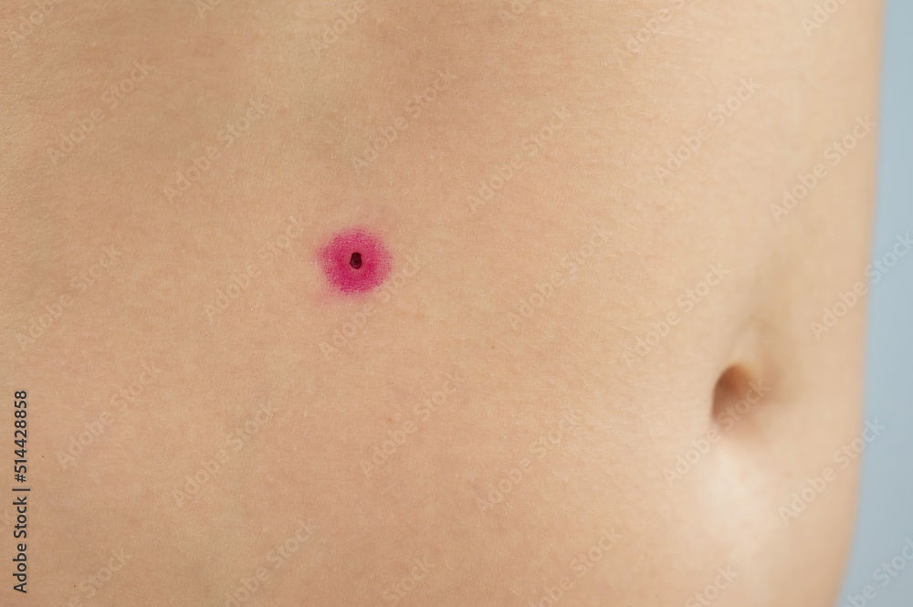Close-up of a removed wart on a woman's abdomen. Human papillomavirus after burning. Close-up of a removed wart on a woman's abdomen. Human papillomavirus after burning.
