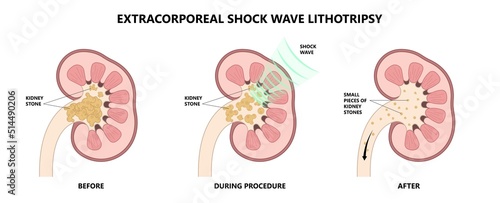 Extracorporeal Shockwave Lithotripsy ESWL kidney stone treatment urinary tract renal calculi treat diagnostic exam blood urea nitrogen BUN percutaneous nephrolithotomy ureteral