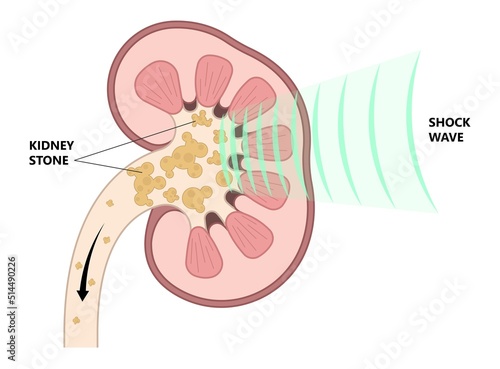 Extracorporeal Shockwave Lithotripsy ESWL kidney stone treatment urinary tract renal calculi treat diagnostic exam blood urea nitrogen BUN percutaneous nephrolithotomy ureteral