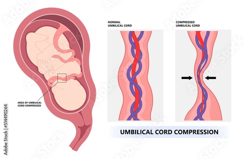 fetal in uterus twins birth labor vasa previa infant baby born c section nuchal cord fetus defect vessels funic growth low lying fluid of PROM test increta cervix Bilobed sac neck knotted Contraction