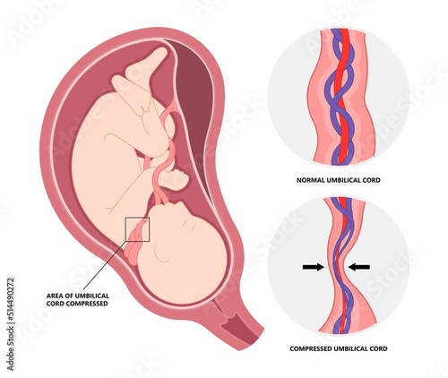 infant baby born and vasa previa fetal c section nuchal cord twins fetus defect vessels funic labor growth low lying birth fluid of PROM test increta cervix Bilobed sac uterus neck knotted Contraction