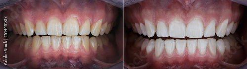 dental photo comparison before and after teeth whitening photo