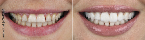 dental photo comparison before and after veneers in a smile