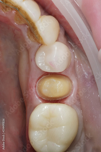 prepared chewing tooth for gluing a ceramic crown