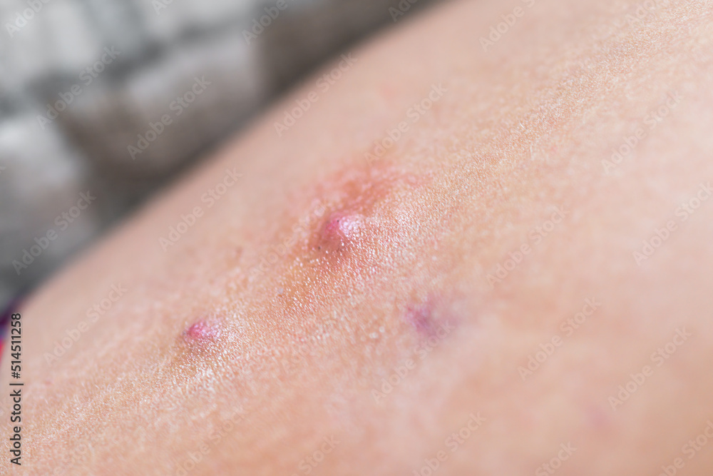 Macro closeup of red swollen boil pimple on leg skin of female woman showing medical condition
