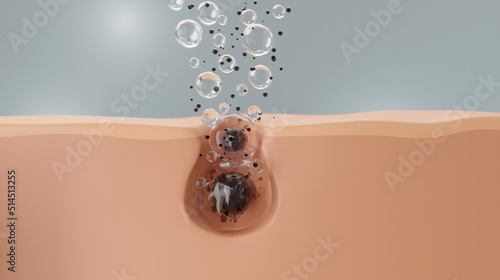 Serum through the skin layer for removing inflammatory acne. 3d rendering. treatment of inflammatory acne and treatment of moderate to severe acne.  photo