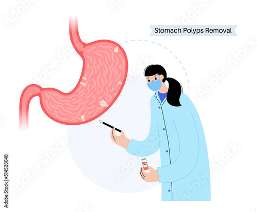 Stomach polyp removal