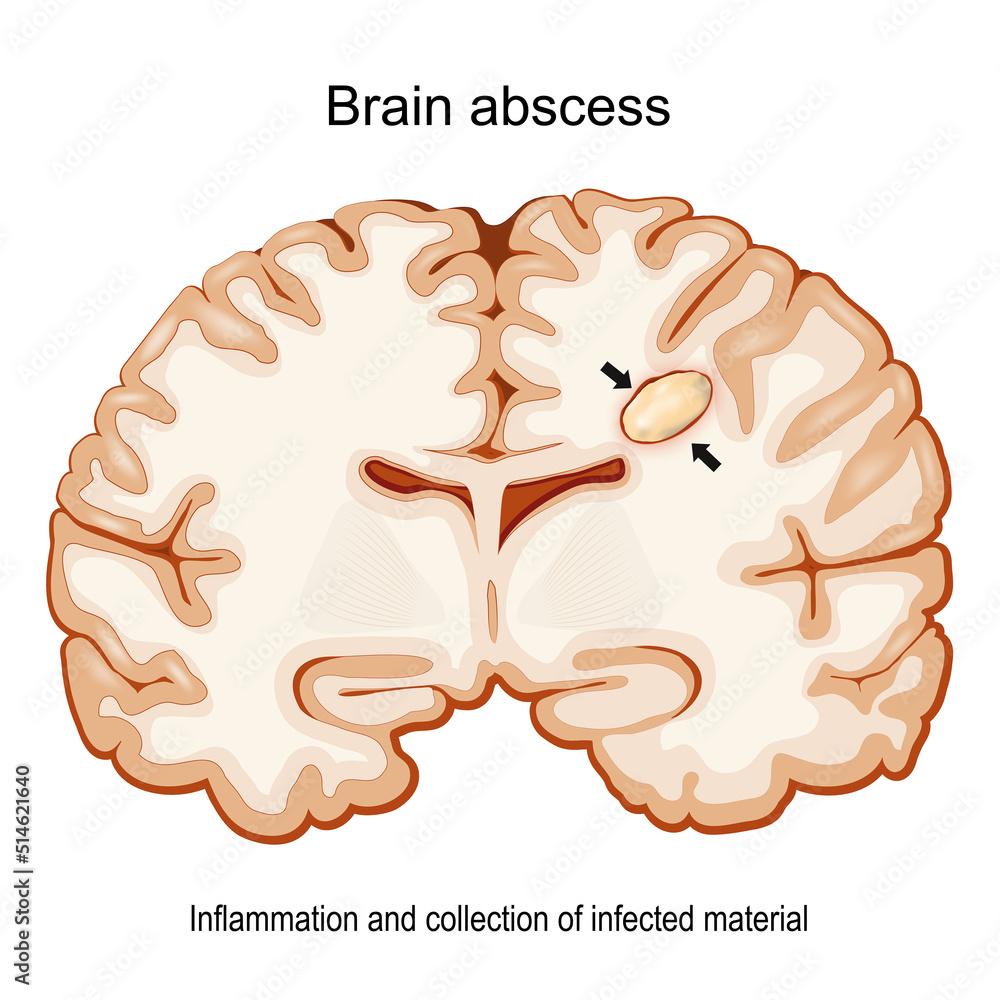 Brain abscess. Cerebral abscess. Cross section of a human brain with