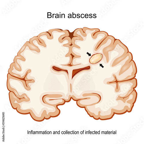 Brain abscess. Cerebral abscess. Cross section of a human brain with intracerebral collection of pus.