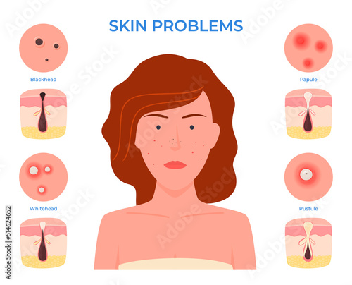 Face of a woman with skin problems. Pimples. Dirty unkempt skin. Vector illustration