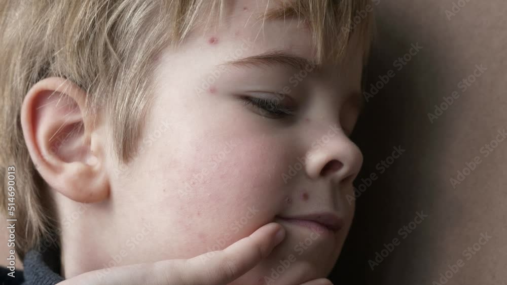 Close-up Kid Face Covered with Rash of Itchy Inflamed Blisters. Chickenpox Infected Boy. Child Disease. 2x Slow motion 60 fps 4K Close-up Kid Face Covered with Rash of Itchy Inflamed Blisters. Chickenpox Infected Boy. Child Disease. 2x Slow motion 60 fps 4K