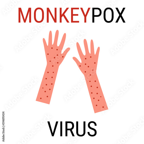 Monkeypox virus zoonotic viral disease that can infect human, nonhuman primates. Monkey pox. Vector illustration