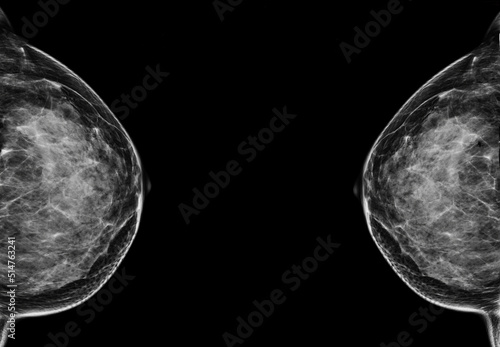 Foto X-ray Digital Mammogram  or mammography  of the breast  CC view.