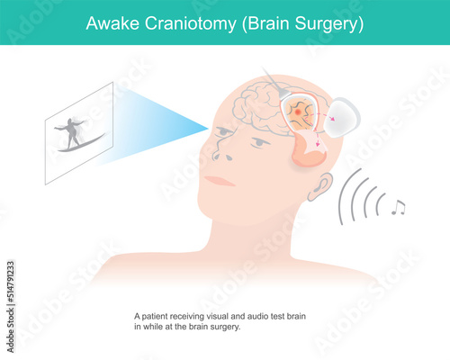 Awake craniotomy. A patient receiving visual and audio test brain in while at brain surgery.