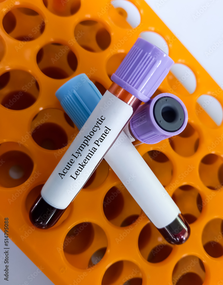 Blood sample for acute lymphocytic leukemia panel test, distinguishing