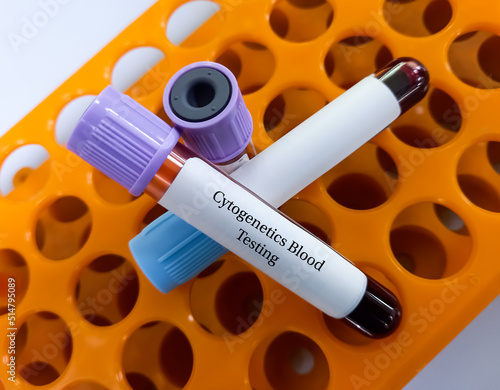 Blood sample for Cytogenetics blood testing to chromosomal analysis of blood for specific gene mutations in certain leukaemias. DNA analysis, chromosomal testing. photo