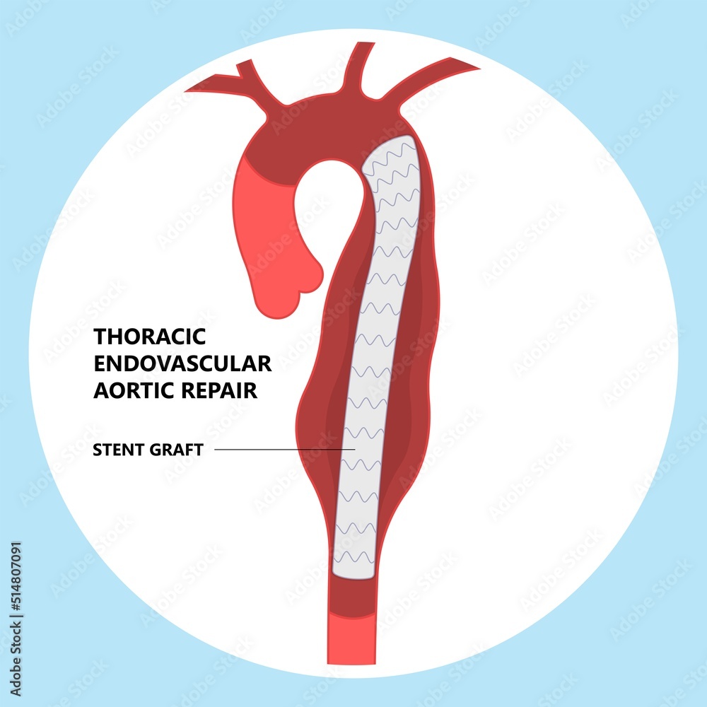 heart blood vessel stent for aorta bulge clots and dilated attack