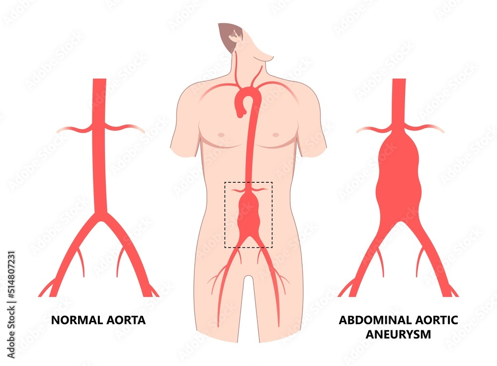left aorta root bulge of Turner Marfan Syndrome chest disorder heart attack stroke graft for