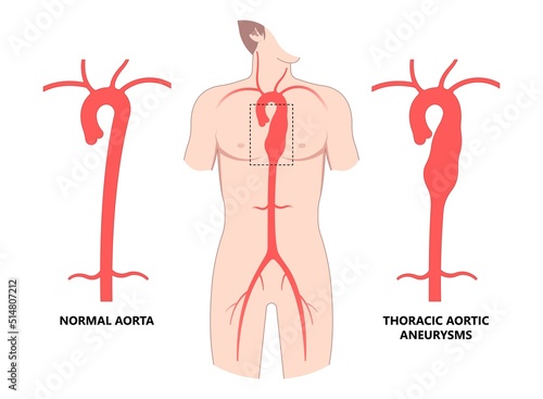 Turner Marfan Syndrome chest disorder heart attack stroke graft for aortic arch pain with hernia blood vessel clots and stent dilated open renal vein kidney damage of root High bulge left aorta photo