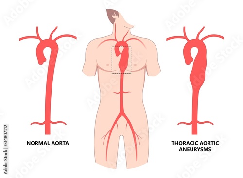 Turner Marfan Syndrome chest disorder heart attack stroke graft for aortic arch pain with hernia blood vessel clots and stent dilated open renal vein kidney damage of root High bulge left aorta