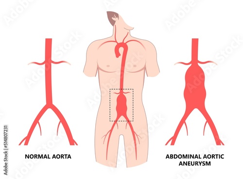 left aorta root bulge of Turner Marfan Syndrome chest disorder heart attack stroke graft for aortic arch pain with hernia high blood vessel clots and stent dilated open renal vein kidney damage